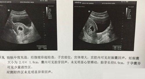 试管婴儿一般多少次成功